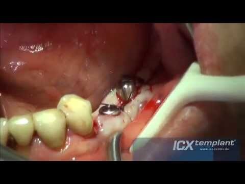 Zertifizierte chirurgische Implantate: Sicher online bestellen